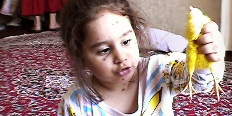 بیماری آبله مرغان